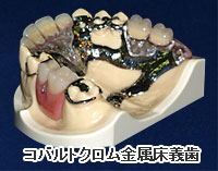 金属床義歯 / 磁性アタッチメント