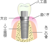 インプラント