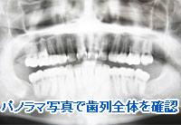 パノラマ写真で歯列全体を確認